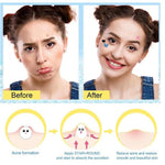 Acne Pimple Patch Penutup Jerawat 36PCS / STARS 28PCS / PURPLE 24PCS