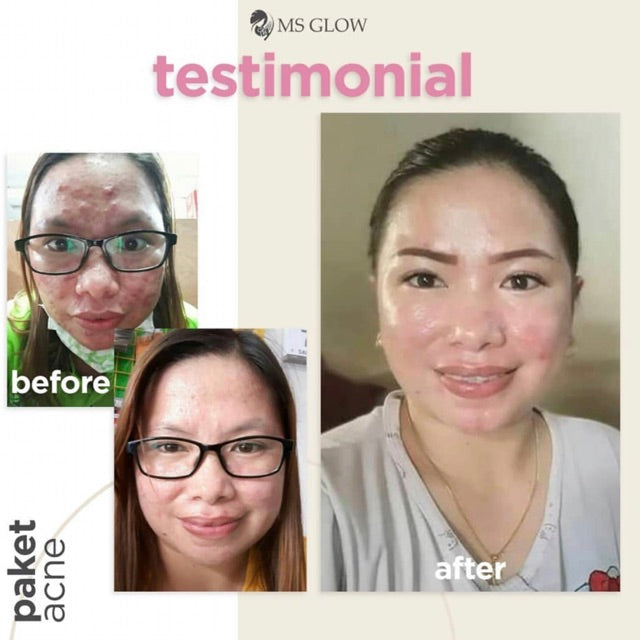 MS glow ACNEZONE AZAGLOW SERUM JERAWAT