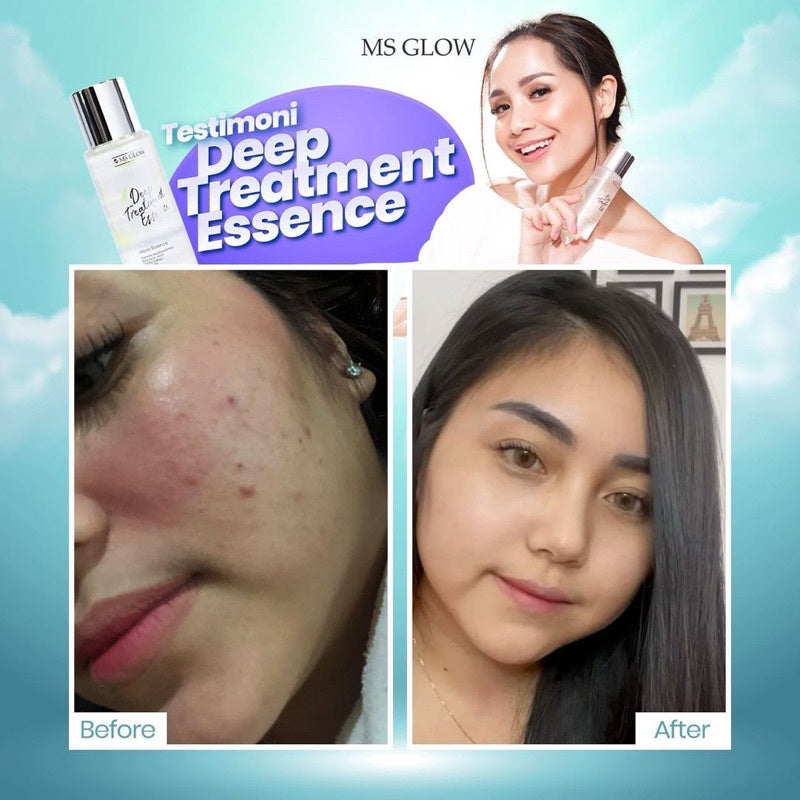 Ms glow DEEP TREATMENT ESSENCE