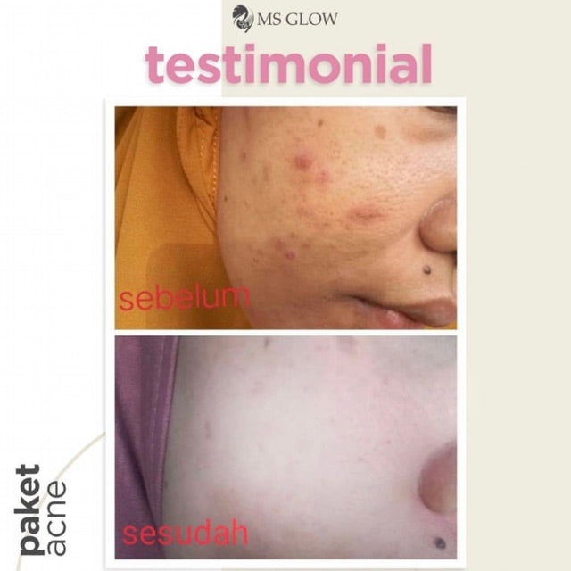 MS glow ACNE Serum