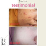 MS glow ACNEZONE AZAGLOW SERUM JERAWAT