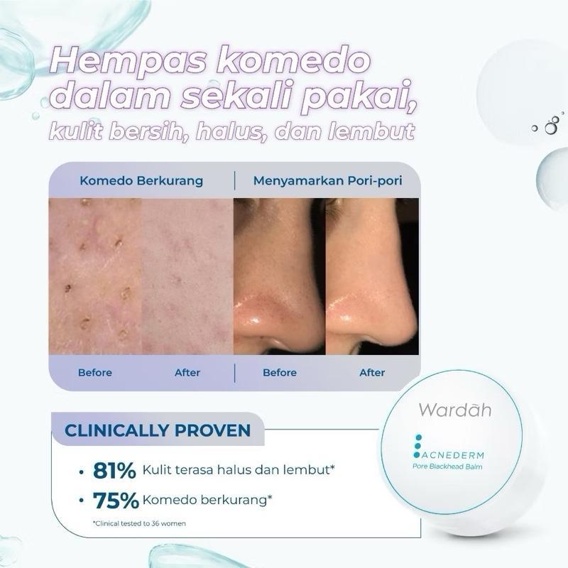 Wardah Acnederm Blackhead Balm with Tea Tree Power – Deep Pore Cleanser & Acne Fighter for Glowing Skin