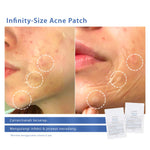 ACNAWAY Infinity Acne Patch – Acne Patch Ukuran Besar 6x2.5cm untuk Jerawat | Breathable, Tipis & Sweatproof | Plester Jerawat Tempel dengan Salicylic Acid + Centella + Mugwort