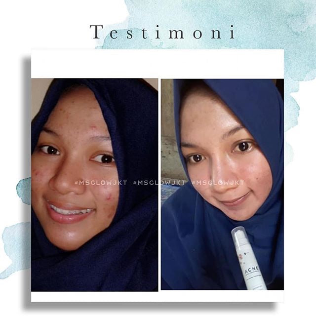 MS glow ACNE Serum