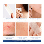 ACNAWAY Infinity Acne Patch – Acne Patch Ukuran Besar 6x2.5cm untuk Jerawat | Breathable, Tipis & Sweatproof | Plester Jerawat Tempel dengan Salicylic Acid + Centella + Mugwort
