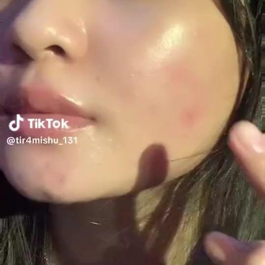 Verile Acne Gel 10g – Fast-Acting Spot Treatment for Pimples & Redness