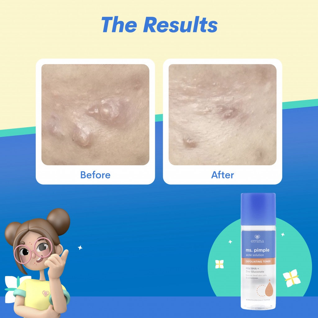 Emina Ms. Pimple Acne Solution Exfoliating Toner 100 mL - Angkat Sel Kulit Mati dan Komedo, Atasi Jerawat dalam 7 Hari!