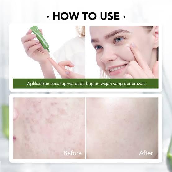 YOU Acne Plus Triple Action Spot Care | YOU Spot Care | YOU Acne Spot Care | Obat Jerawat