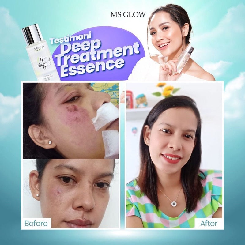 Ms glow DEEP TREATMENT ESSENCE