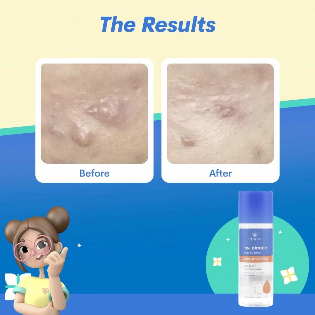 Emina Ms. Pimple Acne Solution Exfoliating Toner 100 mL - Removes Dead Skin Cells and Blackheads, Treats Acne in 7 Days!