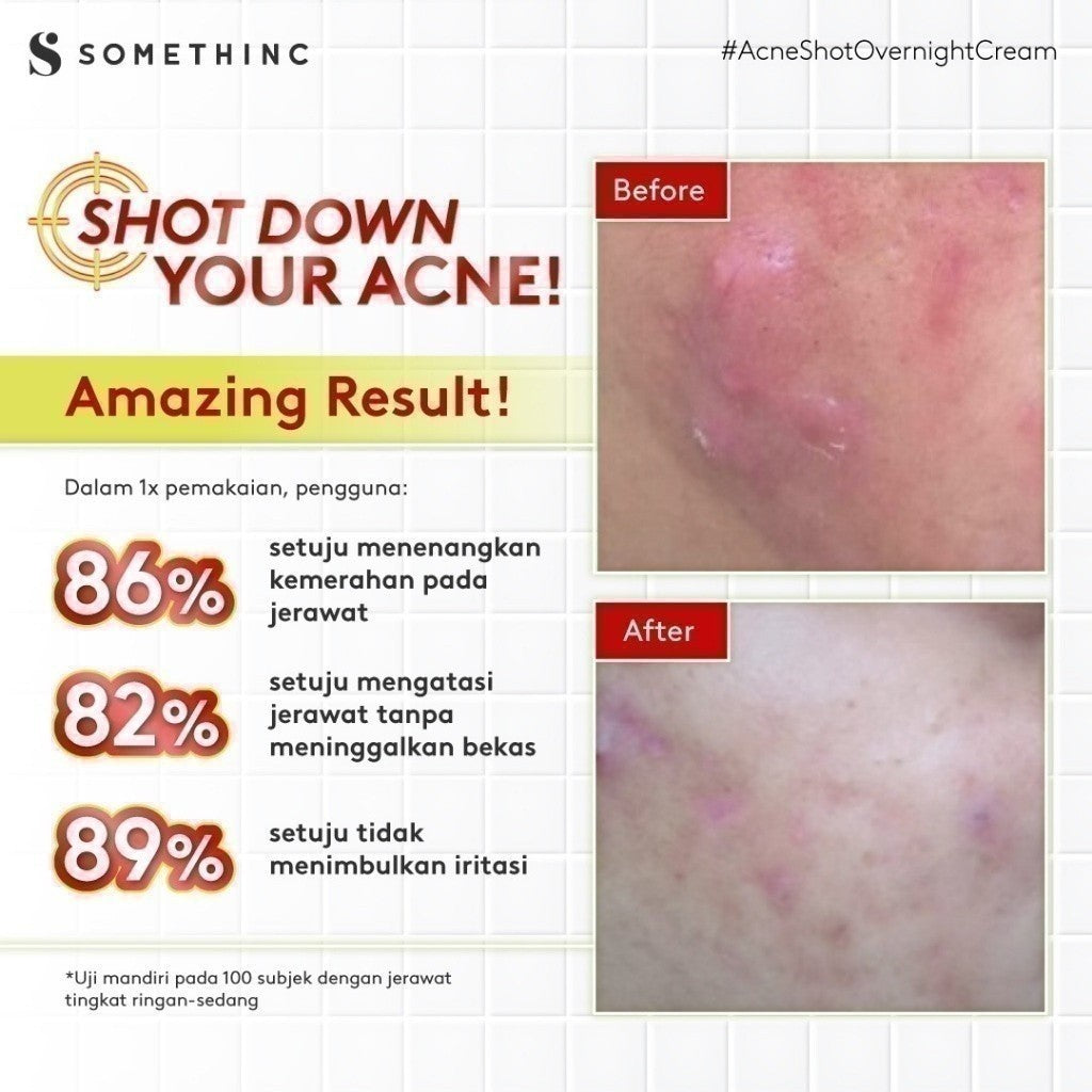 SOMETHINC Acne Shot AC Spot Gel & Overnight Treatment Spot Cream