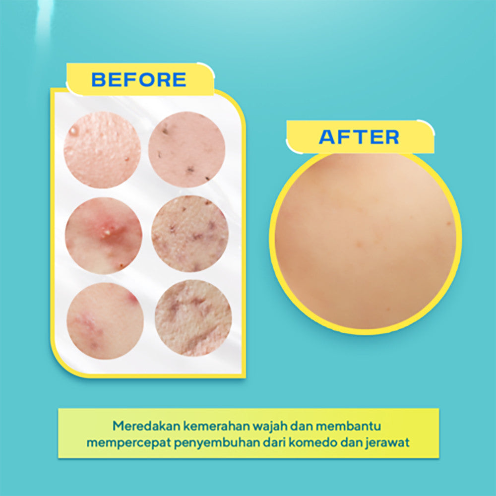 WARDAH Twin pack UV Shield Acne Calming Sunscreen 2 pcs - Skincare