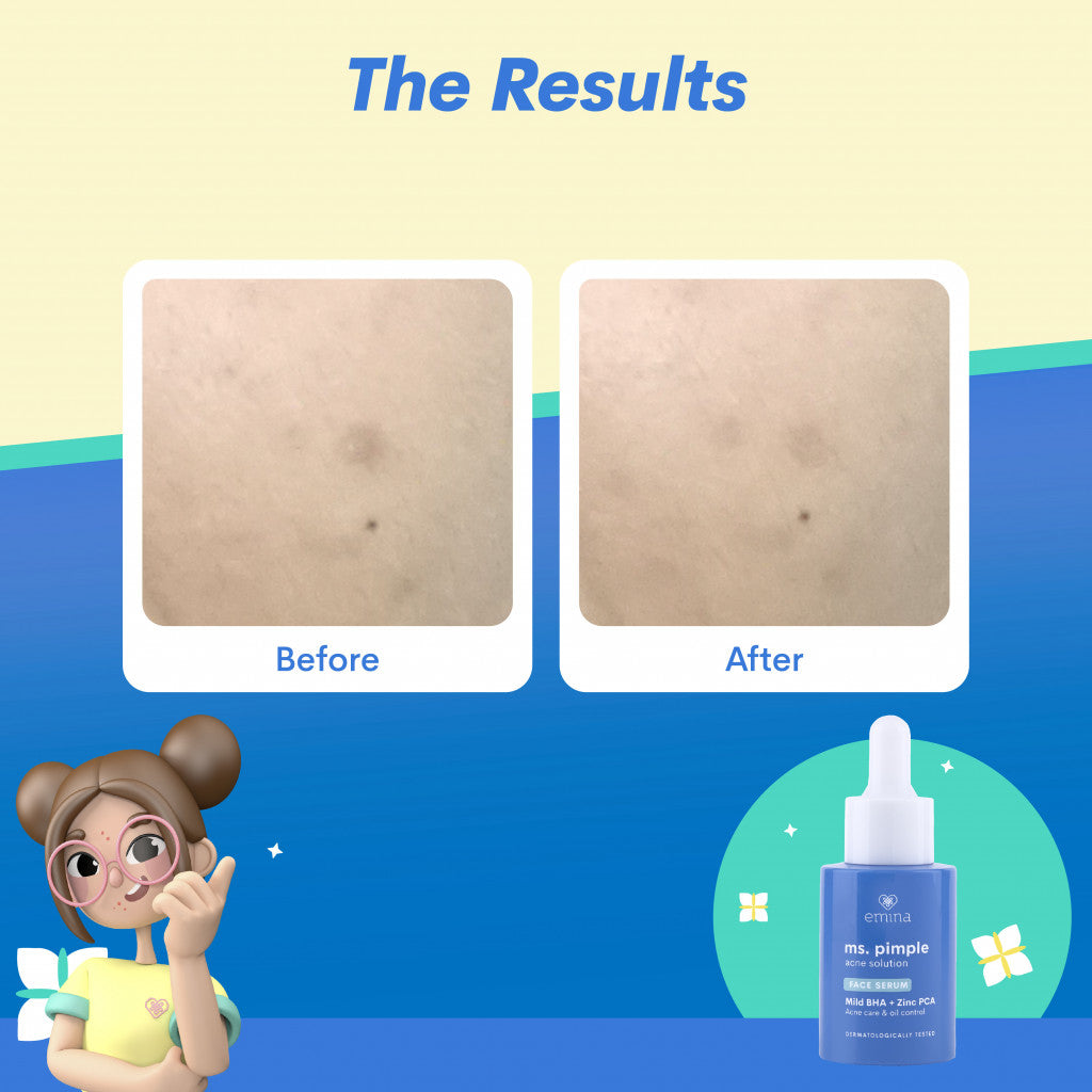 Emina Ms. Pimple Acne Solution Face Toner - Toner Wajah Melembabkan Kulit Berjerawat