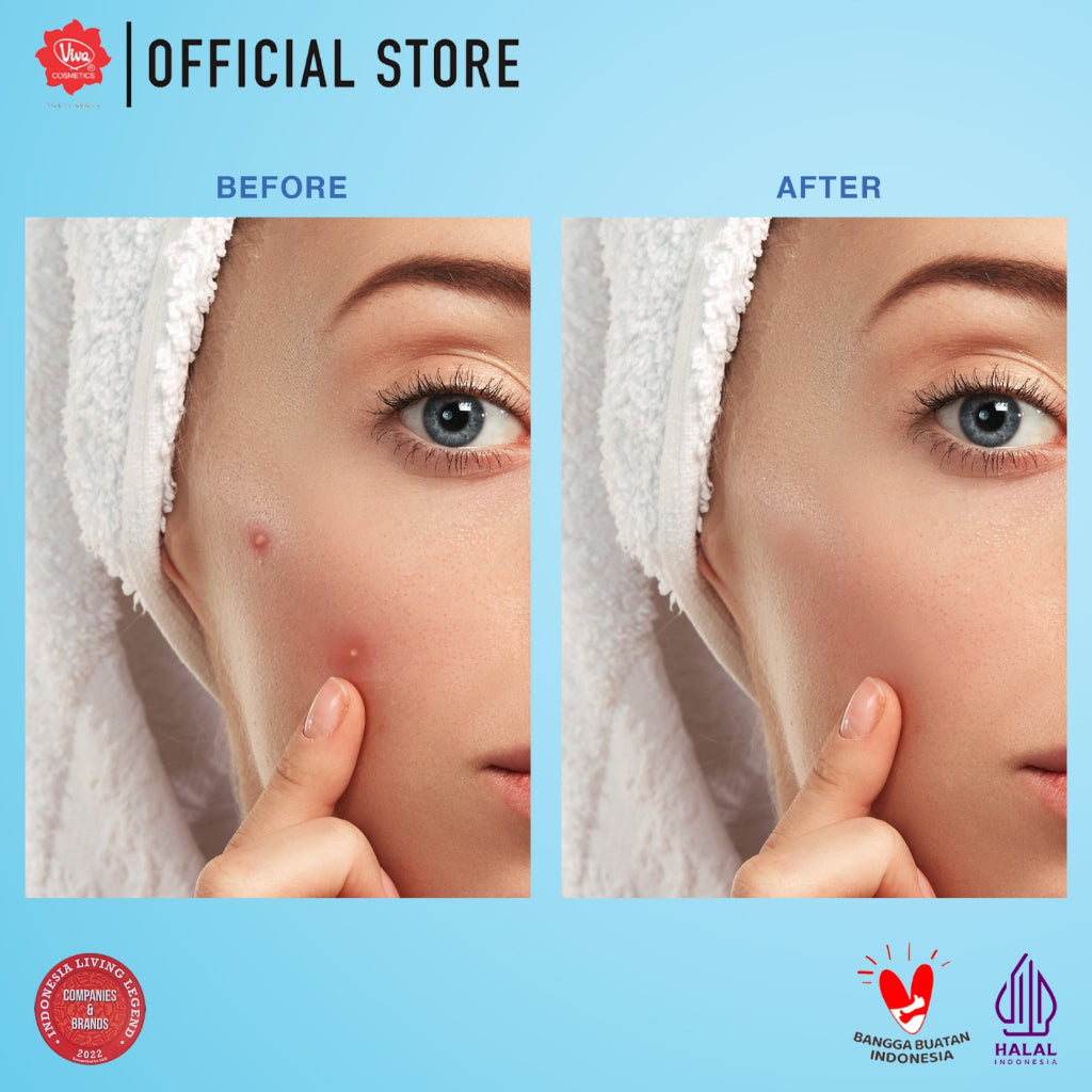 Viva Acne Gel Triple Action with Allantoin & Vit B5 - 15gr