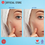 Viva Acne Gel Triple Action with Allantoin & Vit B5 - 15gr