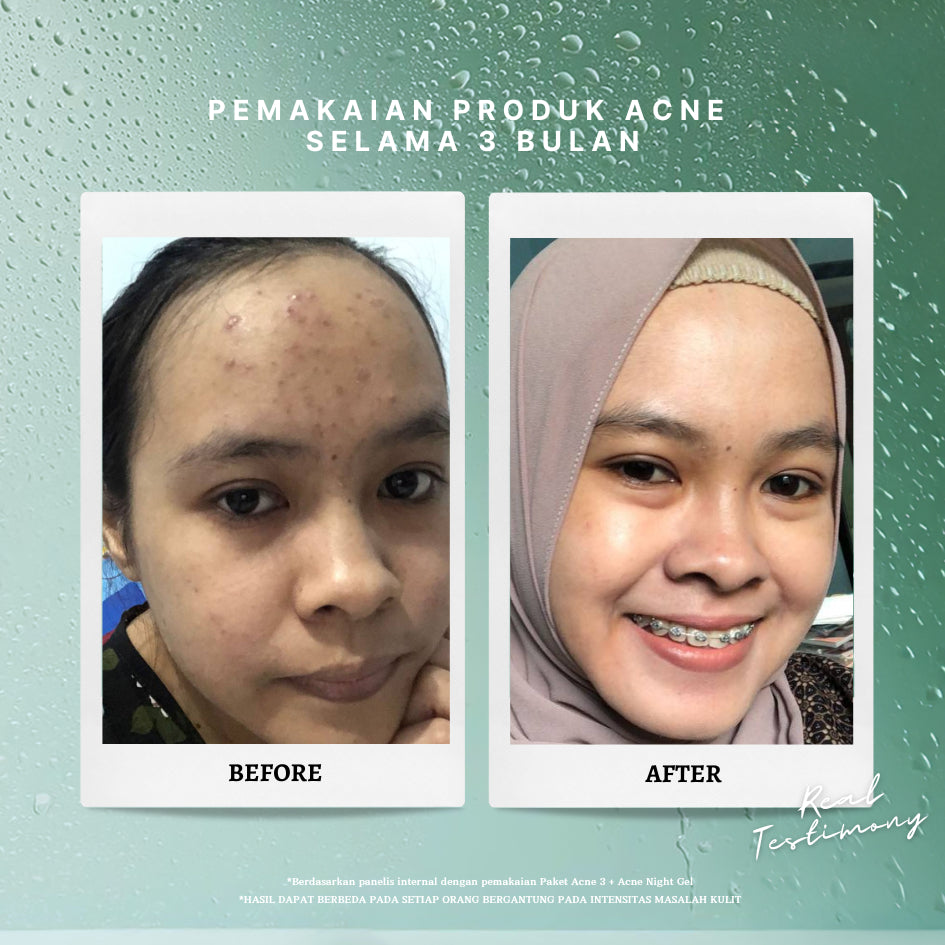 PERSONAL BEAUTY Skincare Set ECO Acne | Perawatan Wajah Berjerawat & Beruntusan - (Tea Tree Oil, Aloe Vera, Niacinamide, Salicylic Acid, Oil Control, Bekas Jerawat)