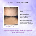 Scarlett Whitening Acne Day Cream - Krim Pagi Penghilang & Perawatan Jerawat Ampuh Atasi Hingga Bekasnya with Double Action Salicylic Acid tanpa Bikin Kulit Iritasi
