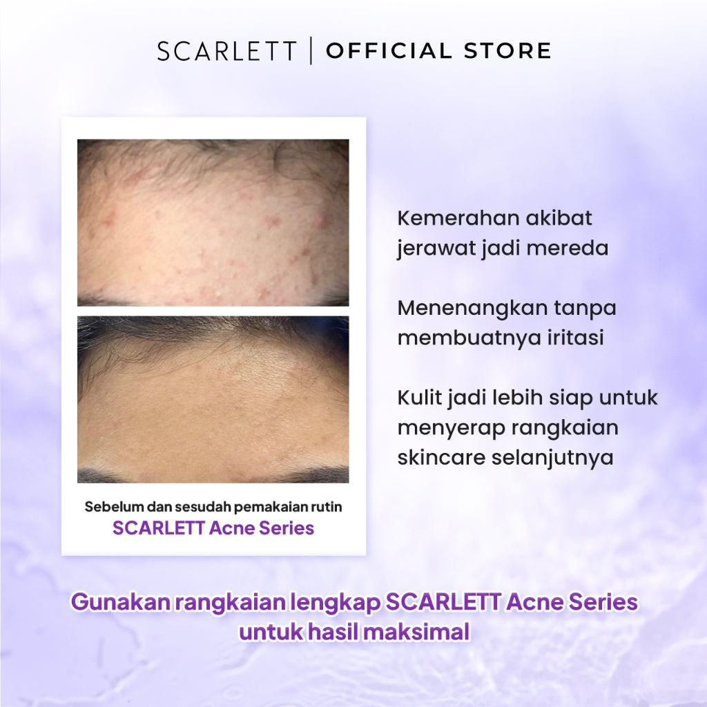 Scarlett Whitening Acne Essence Toner - Toner Ringan Wajah Penghilang & Perawatan Jerawat Ampuh Atasi Hingga Bekasnya with Double Action Salicylic Acid tanpa Bikin Kulit Iritasi