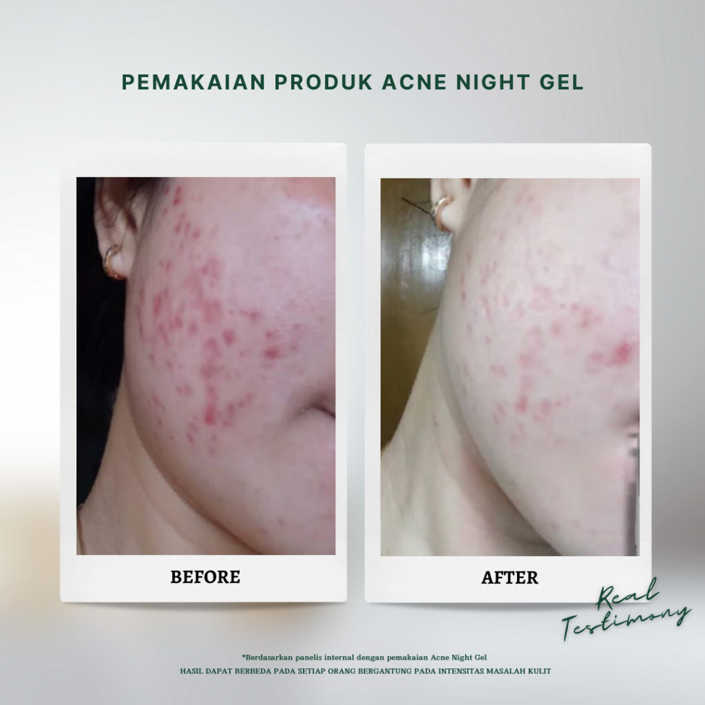 Personal Beauty Acne Night Gel Terapi Peradangan Jerawat Anti Bacterial Exfoliating