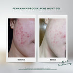 Personal Beauty Acne Night Gel Terapi Peradangan Jerawat Anti Bacterial Exfoliating