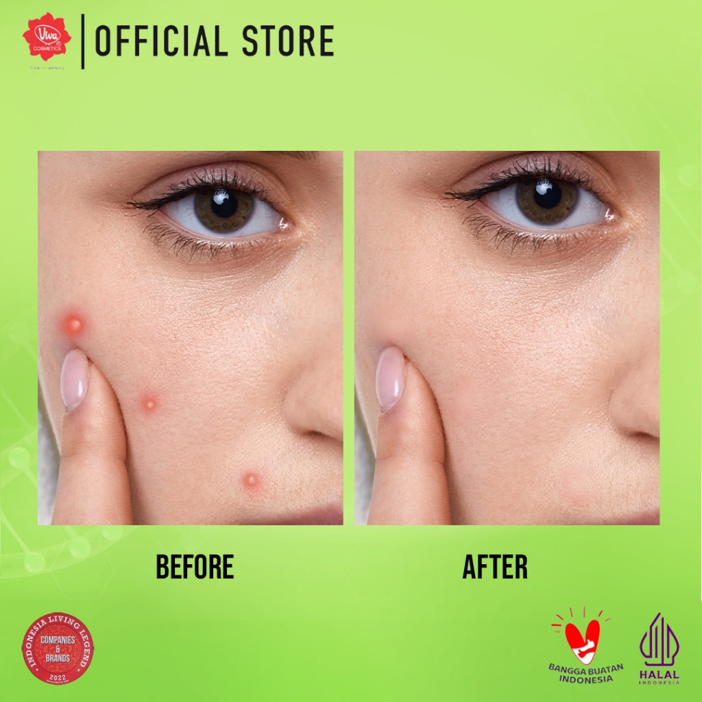 Viva Acne Serum (ANTI JERAWAT) with 4% Niacinamide, 1% Salicylic Acid, & 1 % Centella Asiatica - 20 ml