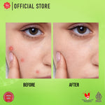 Viva Acne Serum (ANTI JERAWAT) with 4% Niacinamide, 1% Salicylic Acid, & 1 % Centella Asiatica - 20 ml