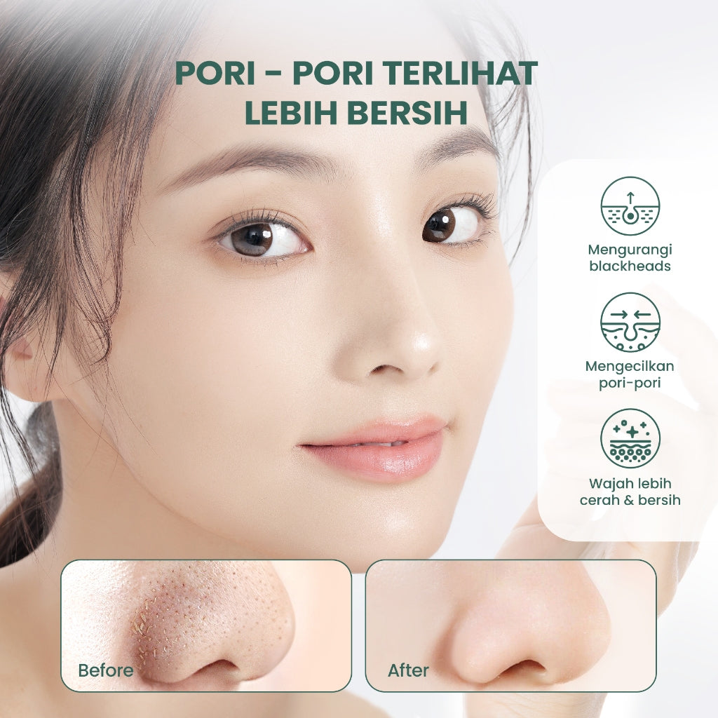 YOU AcnePlus 5X Acids Exfoliating Pads Pads Anti Jerawat Eksfoliasi Kulit Berminyak Bebas Jerawat 30 pads