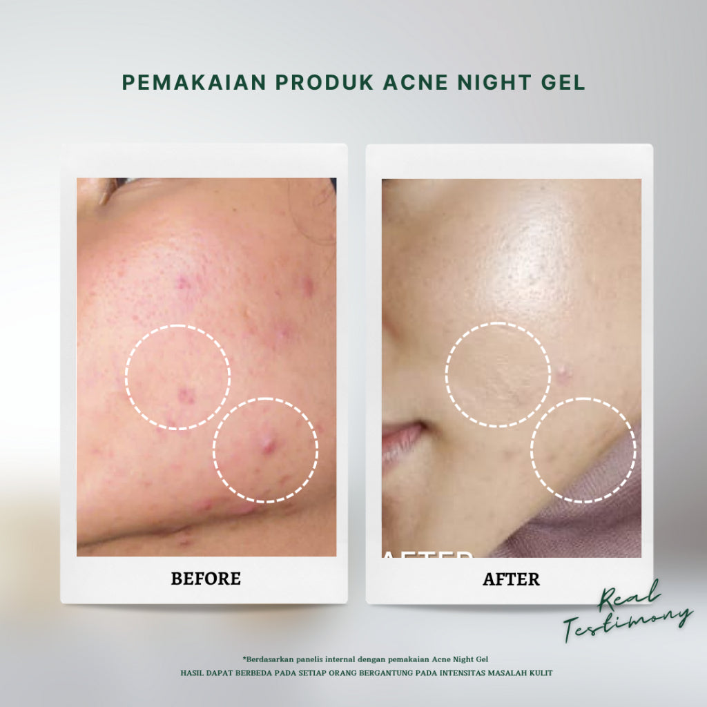 Personal Beauty Acne Night Gel Terapi Peradangan Jerawat Anti Bacterial Exfoliating