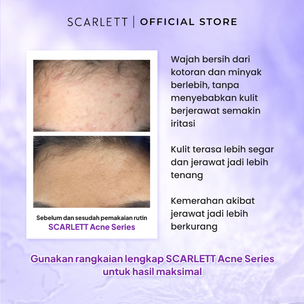 SCARLETT Acne Facial Wash Sabun Cuci Muka untuk Merawat dan Mencegah Pertumbuhan Jerawat dengan Salicylic Acid & Niacinamide