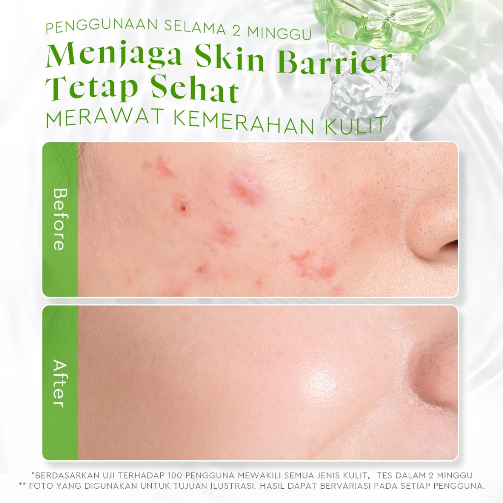 Glad2Glow Centella Ceramide Soothing Toner Acne Toner hydrating toner centella Toner Kulit Jerawat Berminyak Toner eksfoliasi wajah   Acid Complex Madeca Toner jerawat Menenangkan kemerahan pada kulit Melembabkan dan menghidrasi kulit g2g official store