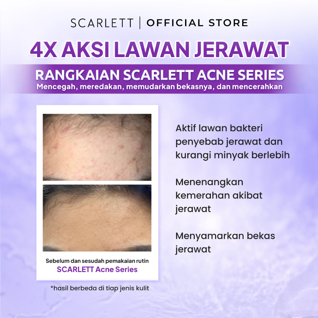 SCARLETT Acne Series - 5in1Paket Lengkap Mencegah & Penghilang Jerawat  2% Salicylic Acid  Serum+Cleanser+Toner+Krim Pagi+Krim Malam