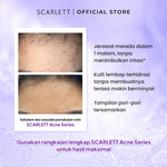 Scarlett Whitening Acne Night Cream - Krim Malam Penghilang & Perawatan Jerawat Ampuh Atasi Hingga Bekasnya with Double Action Salicylic Acid tanpa Bikin Kulit Iritasi