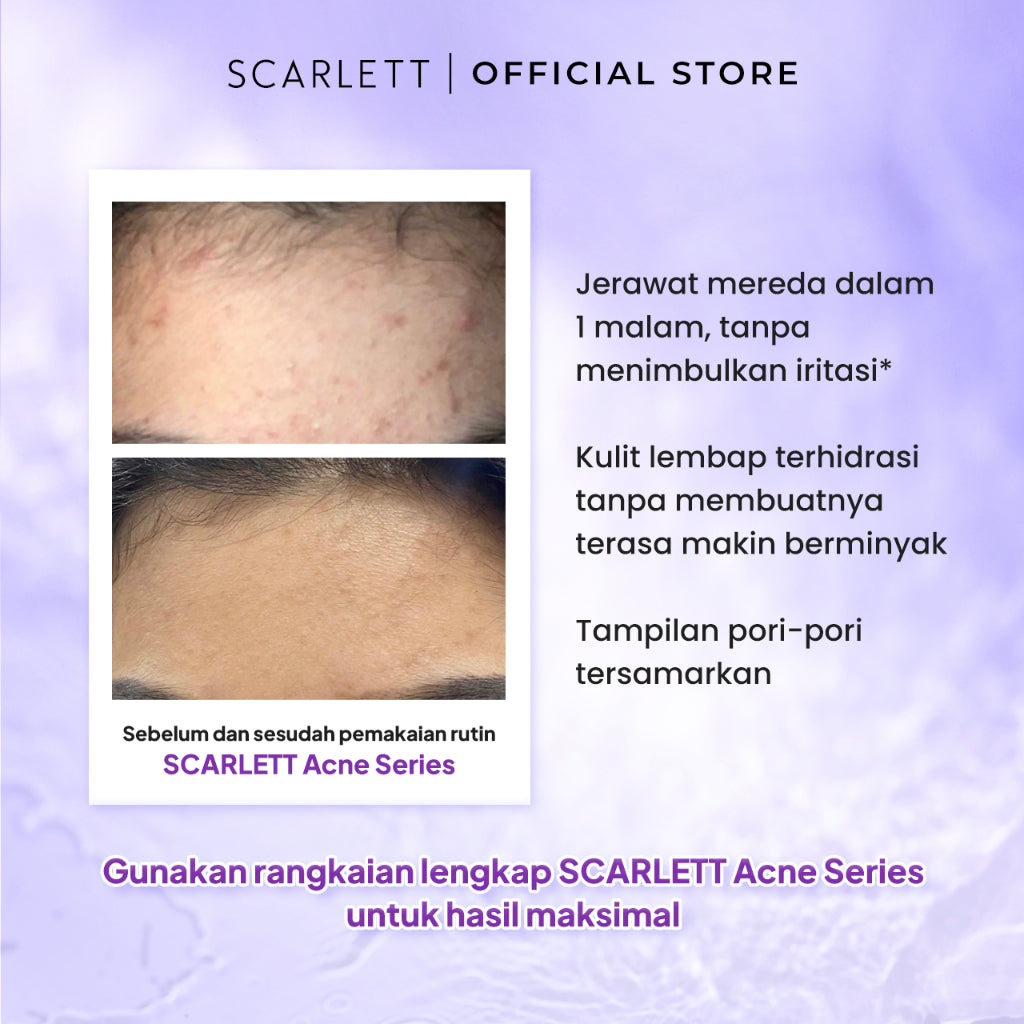 Scarlett Whitening Acne Night Cream - Krim Malam Penghilang & Perawatan Jerawat Ampuh Atasi Hingga Bekasnya with Double Action Salicylic Acid tanpa Bikin Kulit Iritasi