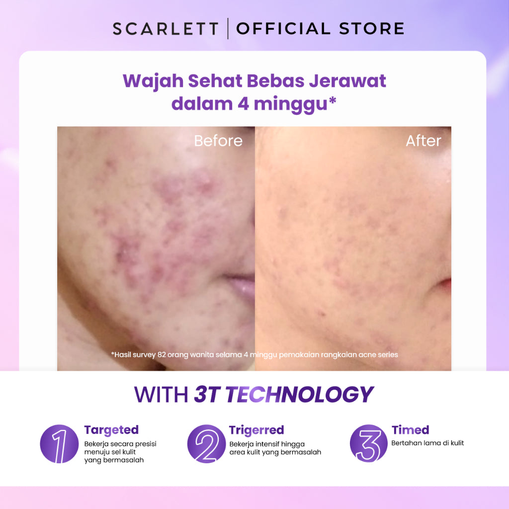 SCARLETT Acne Serum Wajah Penghilang Jerawat , Mencegah Jerawat , Menghilangkan Bekas Jerawat 2% Salicylic Acid