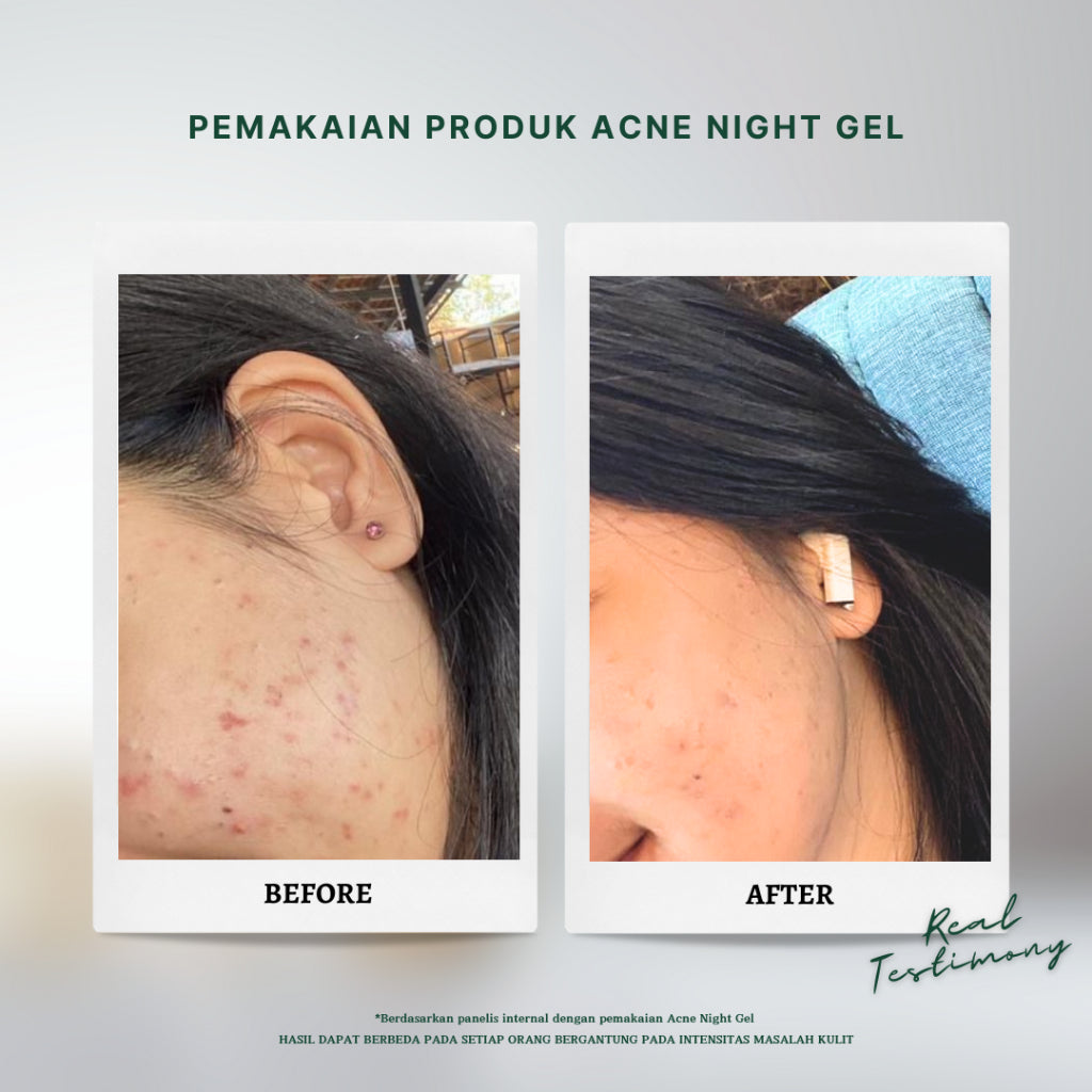 Personal Beauty Acne Night Gel Terapi Peradangan Jerawat Anti Bacterial Exfoliating