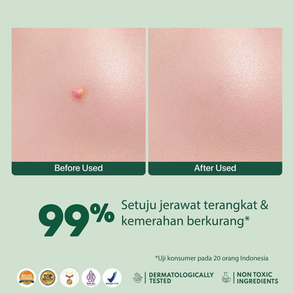 NPURE Acne Clear Patch isi 18Pcs / Ultra thin layer / Patch Jerawat / Acne Skin / Untuk kulit Berjerawat