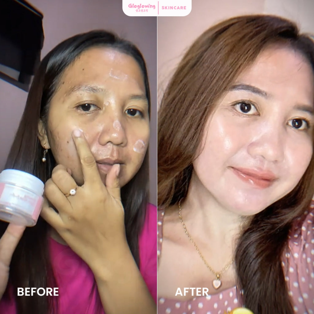GLOGLOWING Day + Night Acne