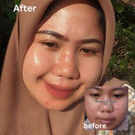 GLOGLOWING Day + Night Acne