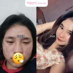 GLOGLOWING Acne Spot Booster 20ml (Obat Totol Jerawat)