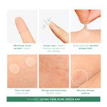 ACNAWAY Bundle 2 in 1 Ultra Thin Acne Patch + Acne Treatment Cream – Plester Jerawat Tipis & Spot Treatment