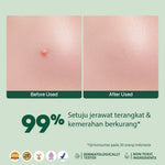 NOT FOR SALE - NPURE Acne Clear Patch isi 18Pcs / Ultra thin layer / Patch Jerawat / Acne Skin / Untuk kulit Berjerawat
