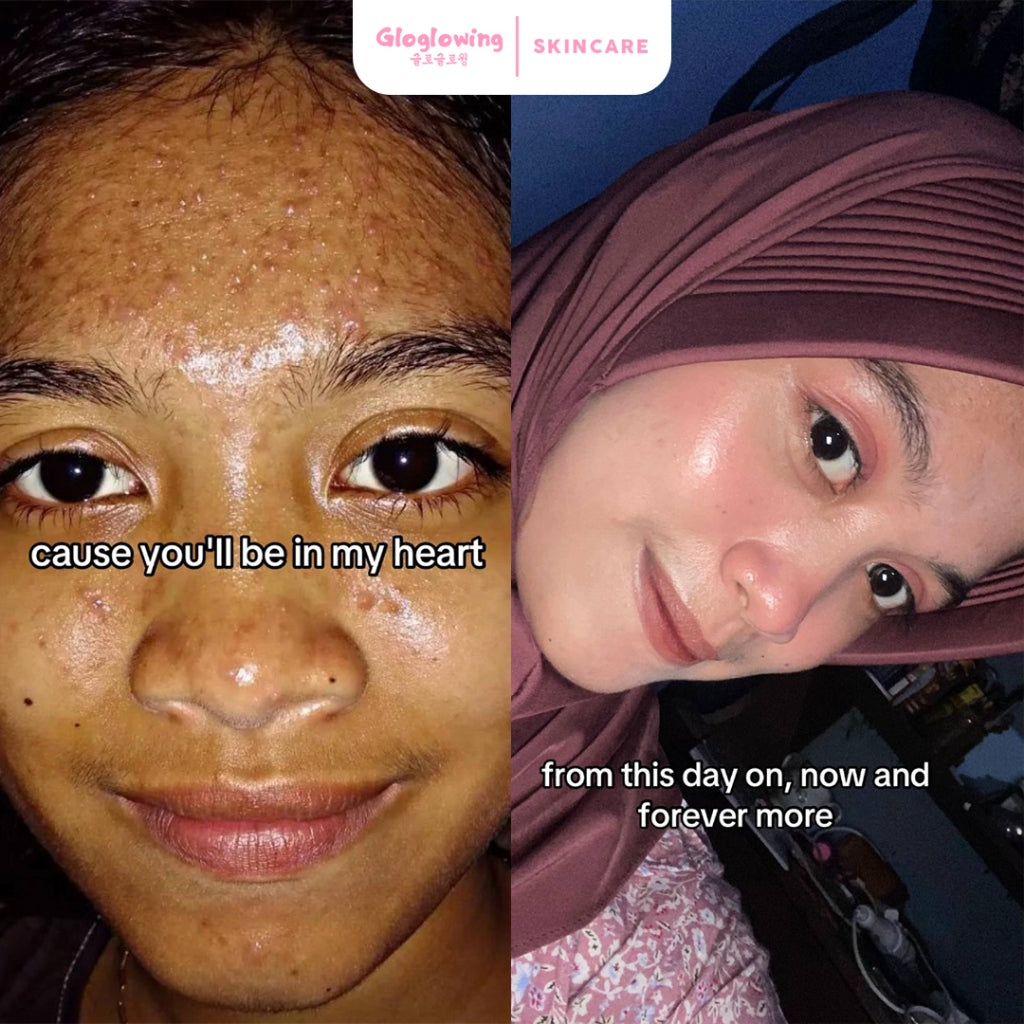 GLOGLOWING Acne Spot Booster 20ml (Obat Totol Jerawat)