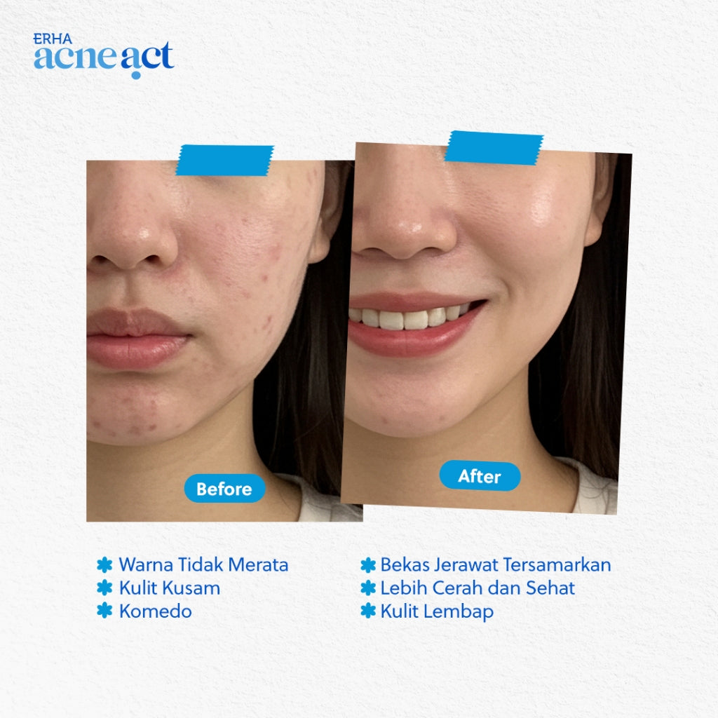 ERHA Acneact Acne Loose Powder 21 g - Bedak Tabur Kulit Jerawat | Non Comedogenic | Non Acnegenic