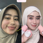GLOGLOWING Acne Spot Booster 20ml (Obat Totol Jerawat)