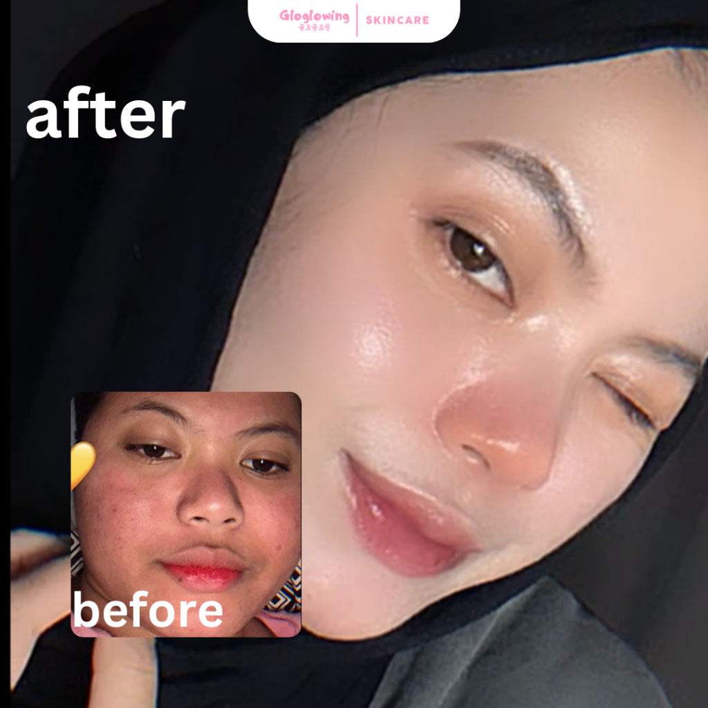 GLOGLOWING Day + Night Acne