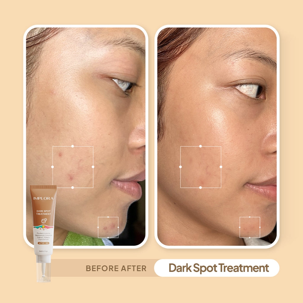 Implora Dark Spot Treatment | Mencerahkan Bekas Jerawat | Menyamarkan noda hitam