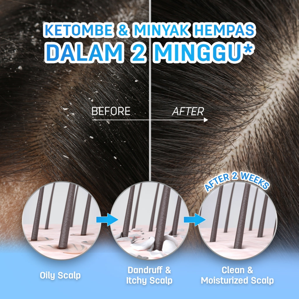 [GEL ANTI KETOMBE] ERHAIR Scalperfect Exfoliating Gel 65gr - Gel Eksfoliasi kulit kepala Anti Ketombe dan Seboroik | 2% Salicylic Acid