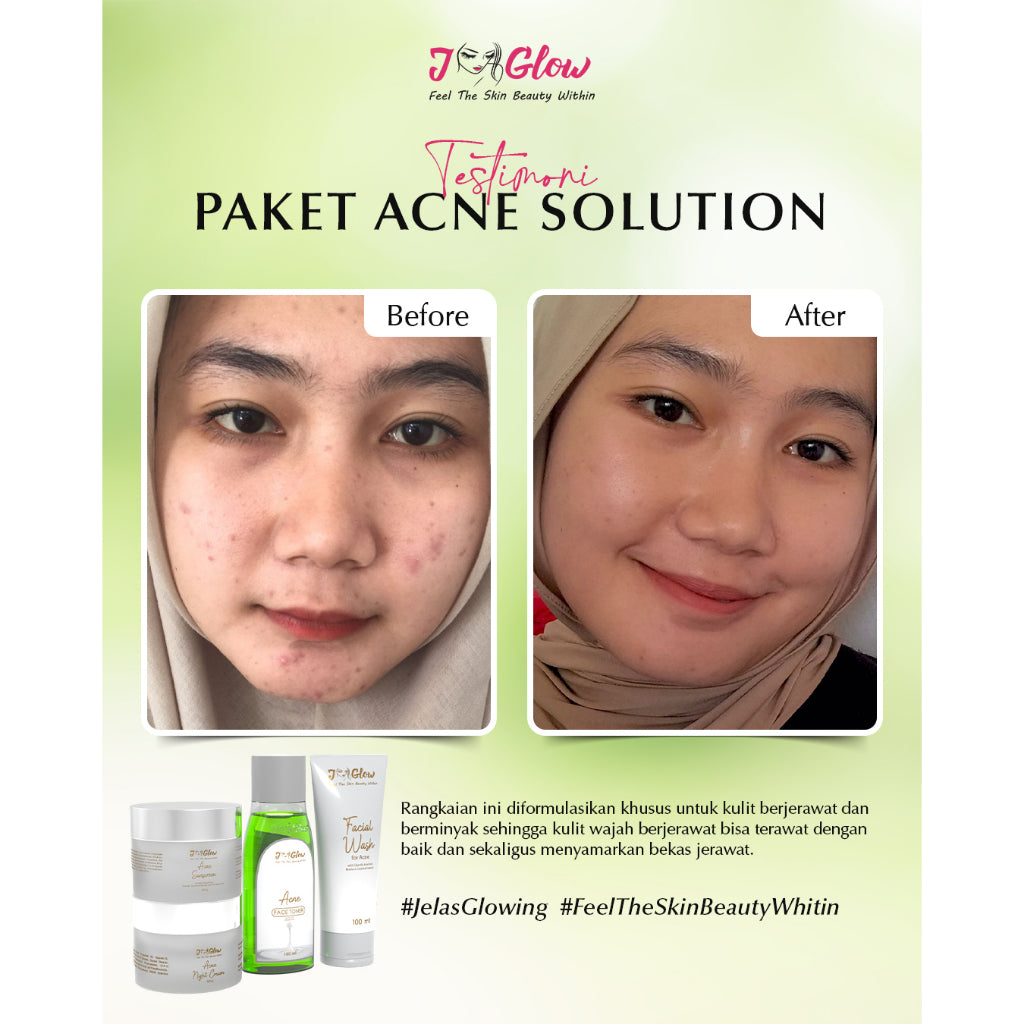 Jglow Skincare Paket Kulit Berjerawat Acne (Perawatan Kulit Bejerawat) - 4pcs
