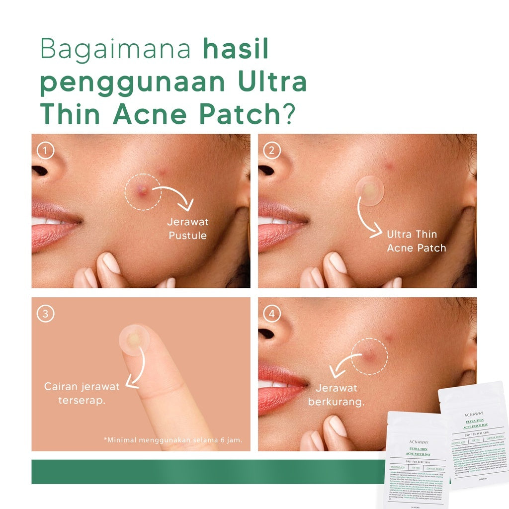 ACNAWAY Bundle 2 in 1 Ultra Thin Acne Patch + Acne Treatment Cream – Plester Jerawat Tipis & Spot Treatment