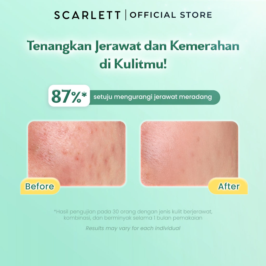 SCARLETT Low pH Acne Peace Gel Cleanser-Facial Wash Gentle Sabun Cuci Muka Low pH, Kulit Tidak Ketarik, Basic Skincare Anti Jerawat, Aman Untuk Kulit Sensitif Aman untuk Skin Barrier, Untuk Kulit Berjerawat dan Berminyak, Membersihkan Kotoran dan Minyak